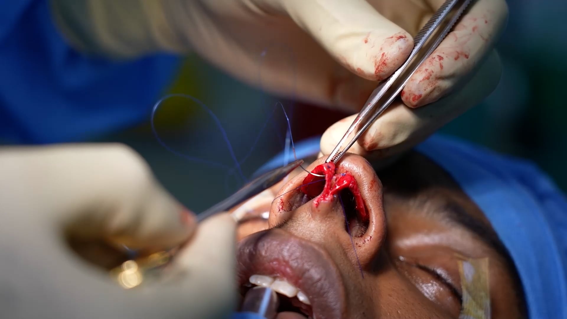 Dorsal hump correction surgery- Rhinoplasty